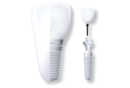 dental implant fixture