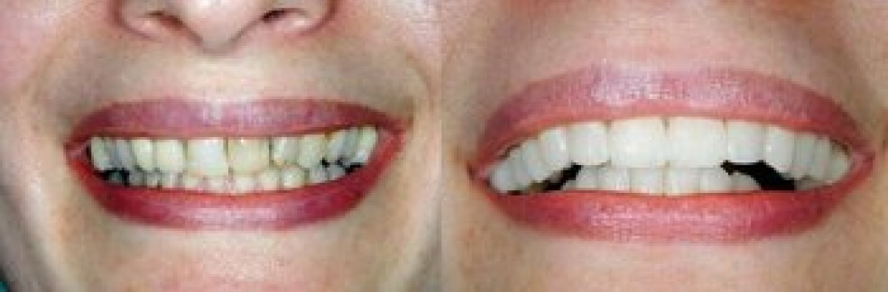 before and after smile restoration - dentist in east lansing