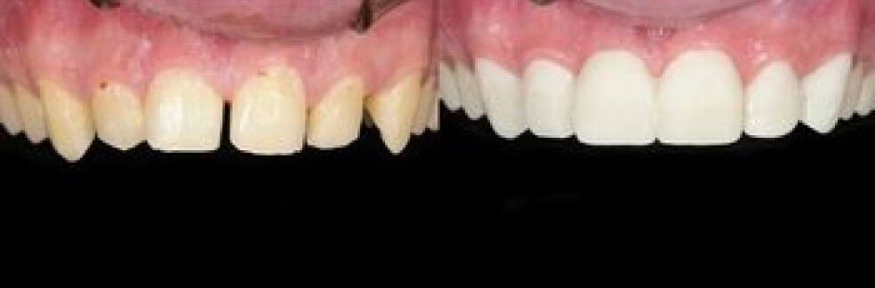 before and after smile restoration - dentist in east lansing