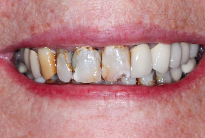 teeth before restoration