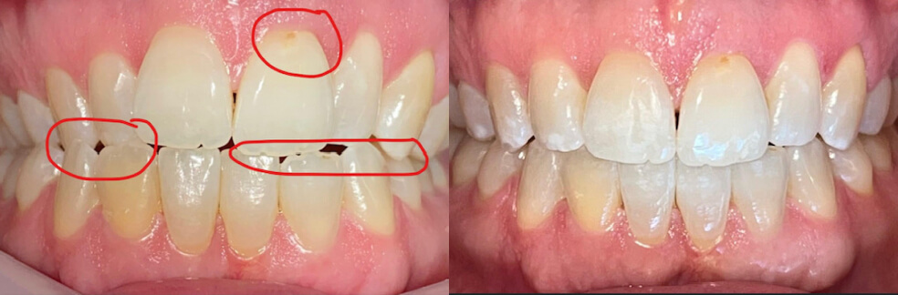 before and after photos - east landing dentist