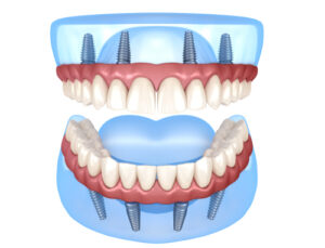 implant supported dentures