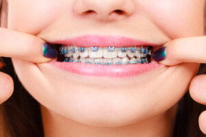 traditional metal braces